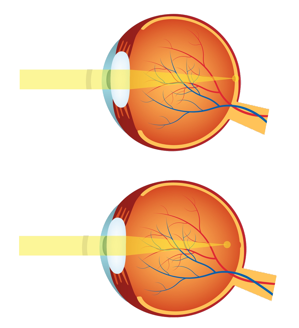 Normal vs Myopic Eye